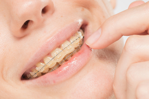 Why Clear Braces For Teens Are Recommended