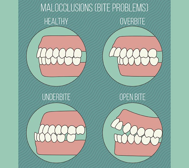 Irving Malocclusions
