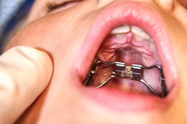 Orthodontic Expanders: Commonly Asked Questions