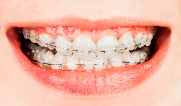 Preparing For Your First Orthodontic Visit