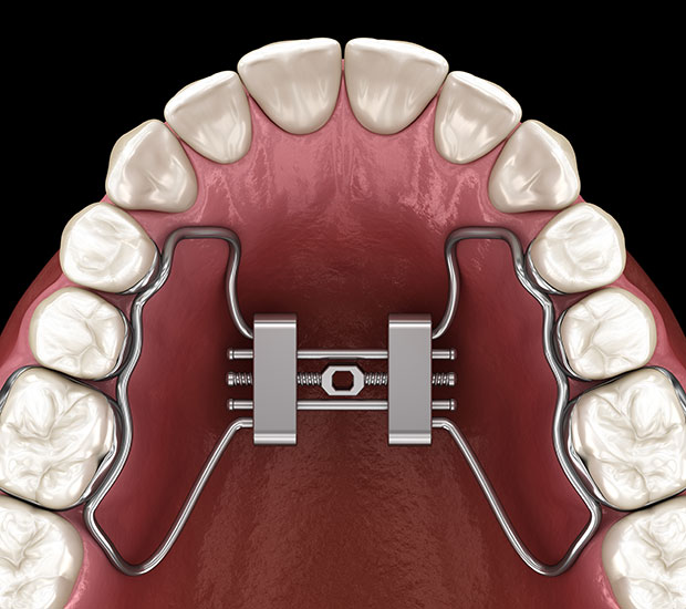 Irving Palatal Expansion