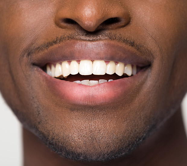 Irving Teeth Straightening
