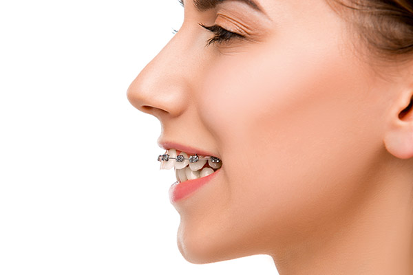 Orthodontist Treatment Options for an Overbite from Valley Ranch Orthodontics in Irving, TX
